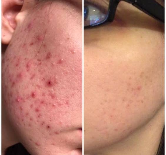 acne] Tons of small acne papules on chest out of nowhere - wedding is in  2.5 months - help me understand what is causing this! (Products and routine  are in comments) : r/SkincareAddiction