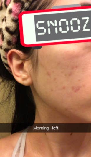 Reviewer's cheek with less acne spots after using Ebanel's Acne Spot Treatment Drying Lotion