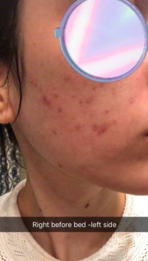 Reviewer's cheek with acne spots before applying Ebanel's Acne Spot Treatment Drying Lotion 