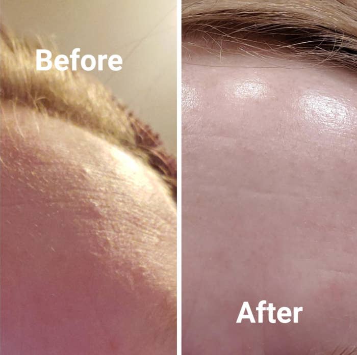 A reviewer's forehead originally has small bumps and acne, but looks smooth and healthy after using the exfoliator