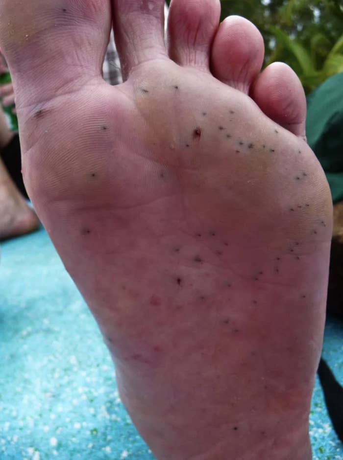 A foot with multiple wounds on the bottom from sea urchin spines.