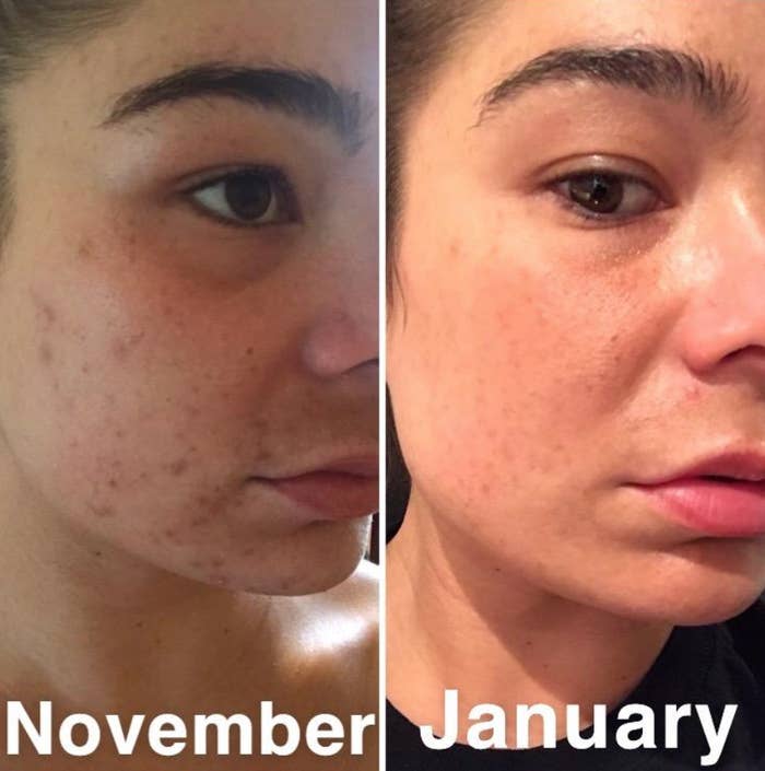 A reviewer's cheek and jaw have a lot of acne and dark spots but is much clearer, with the dark spots mostly faded, three months later