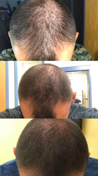 A reviewer showing a progression of images that tracks their hair growth after using the product