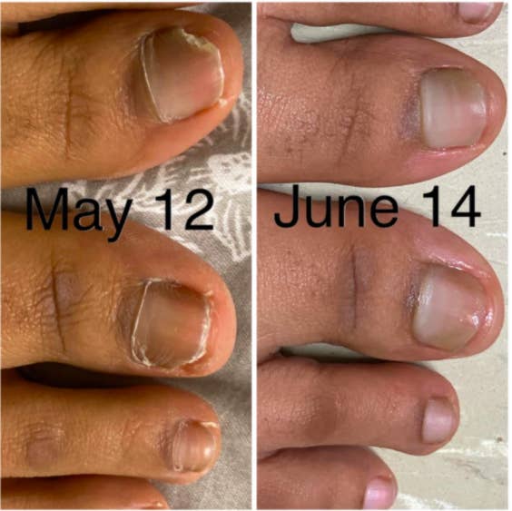 On the left, a reviewer's toenails looking uneven and fungus-y, with the text 