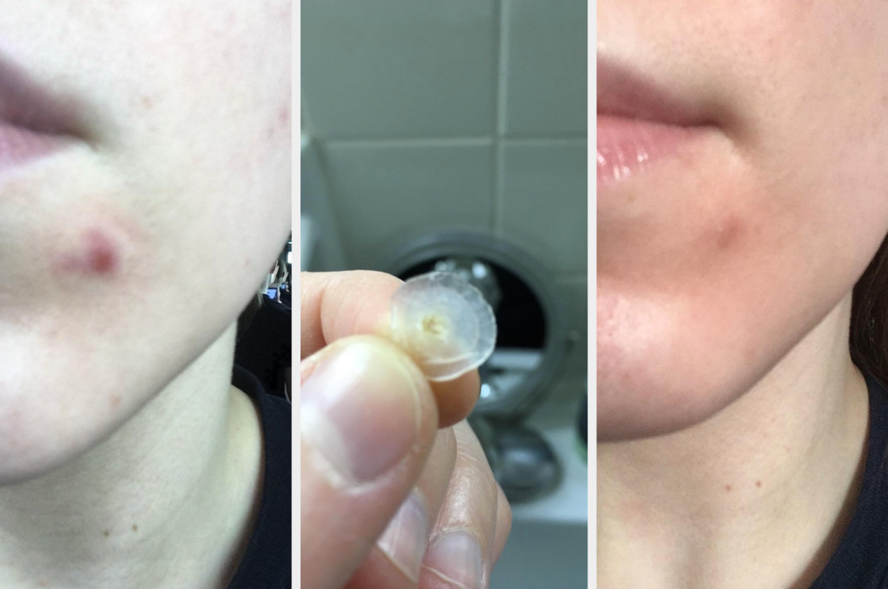 A reviewer image of an acne spot, then another of the patch, then an &quot;after&quot; pic of the same acne spot looking much less red and raised 