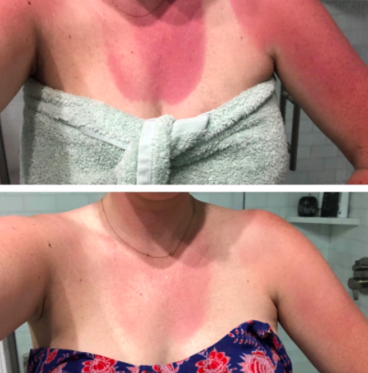 Above, the reviewer&#x27;s pink sunburned chest before using the lotion. Below, the reviewer&#x27;s slightly less red chest after using the lotion