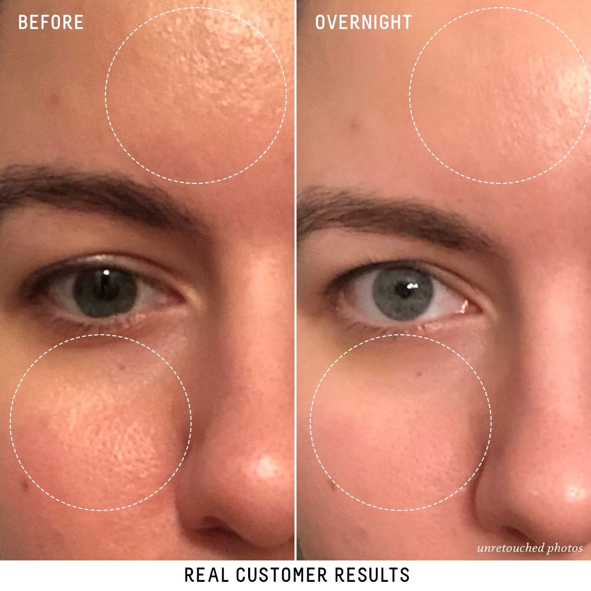 user before and after showing textured skin and open pores, then smooth poreless skin after using product