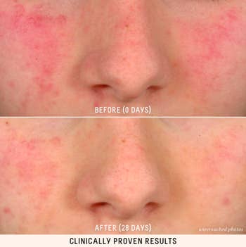 A before and after photo showing the reduced redness caused by using Biossance's Squalane + Probiotic Gel Moisturizer for a moisturizer