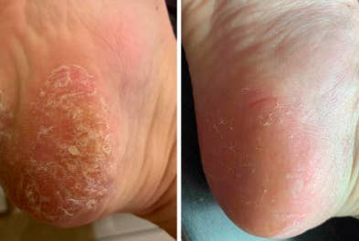 17 Products That Might Actually Help With Foot Fungus