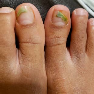 Toenail Fungus Symptoms & Fungal Infection Treatment - Advanced Foot & Ankle