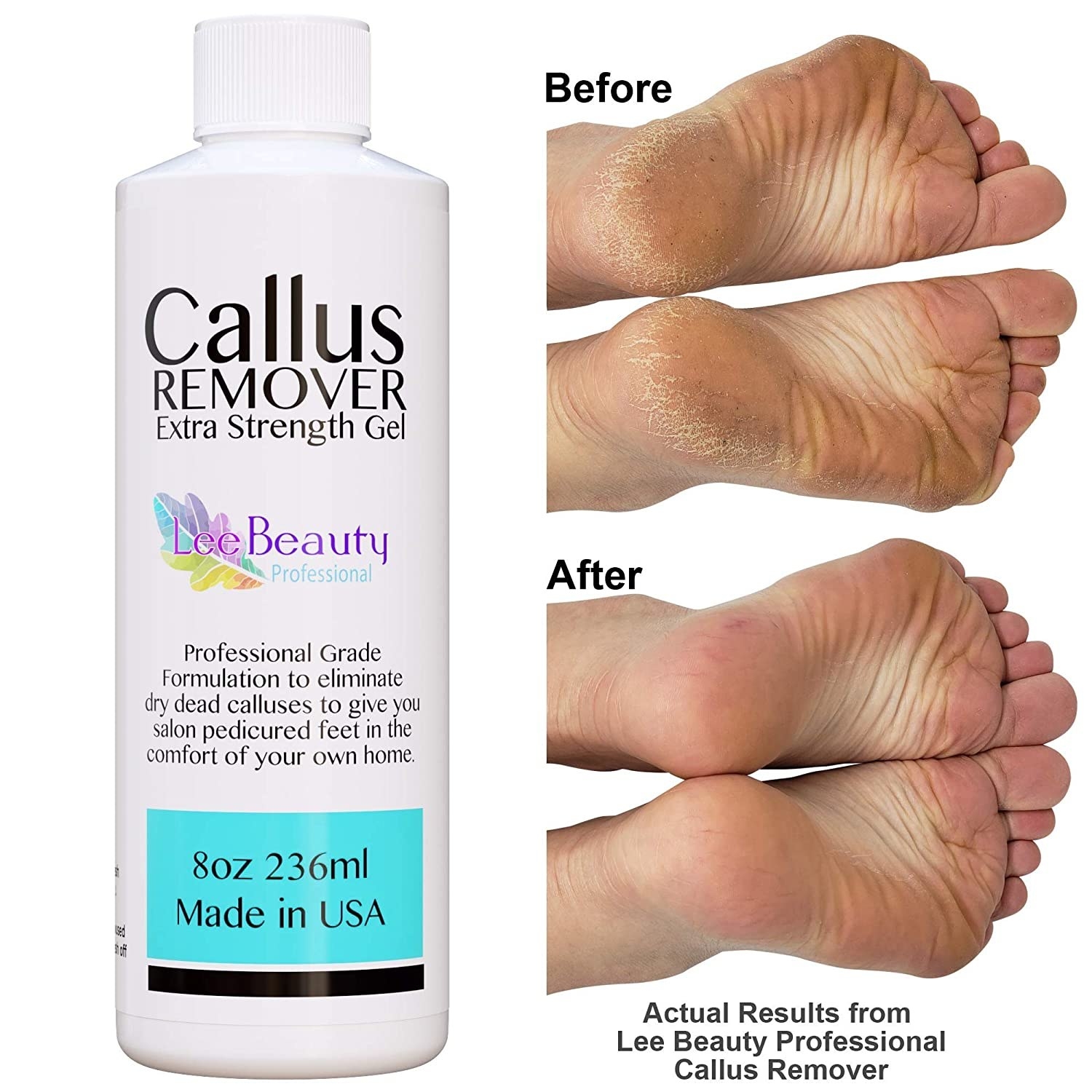 Blue Cross Professional Extra Strength Callus Remover Gel