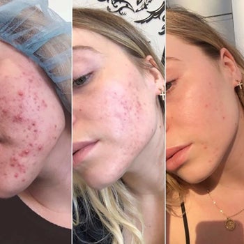 model with visible acne on left; moderate acne in middle; and almost no acne on right 