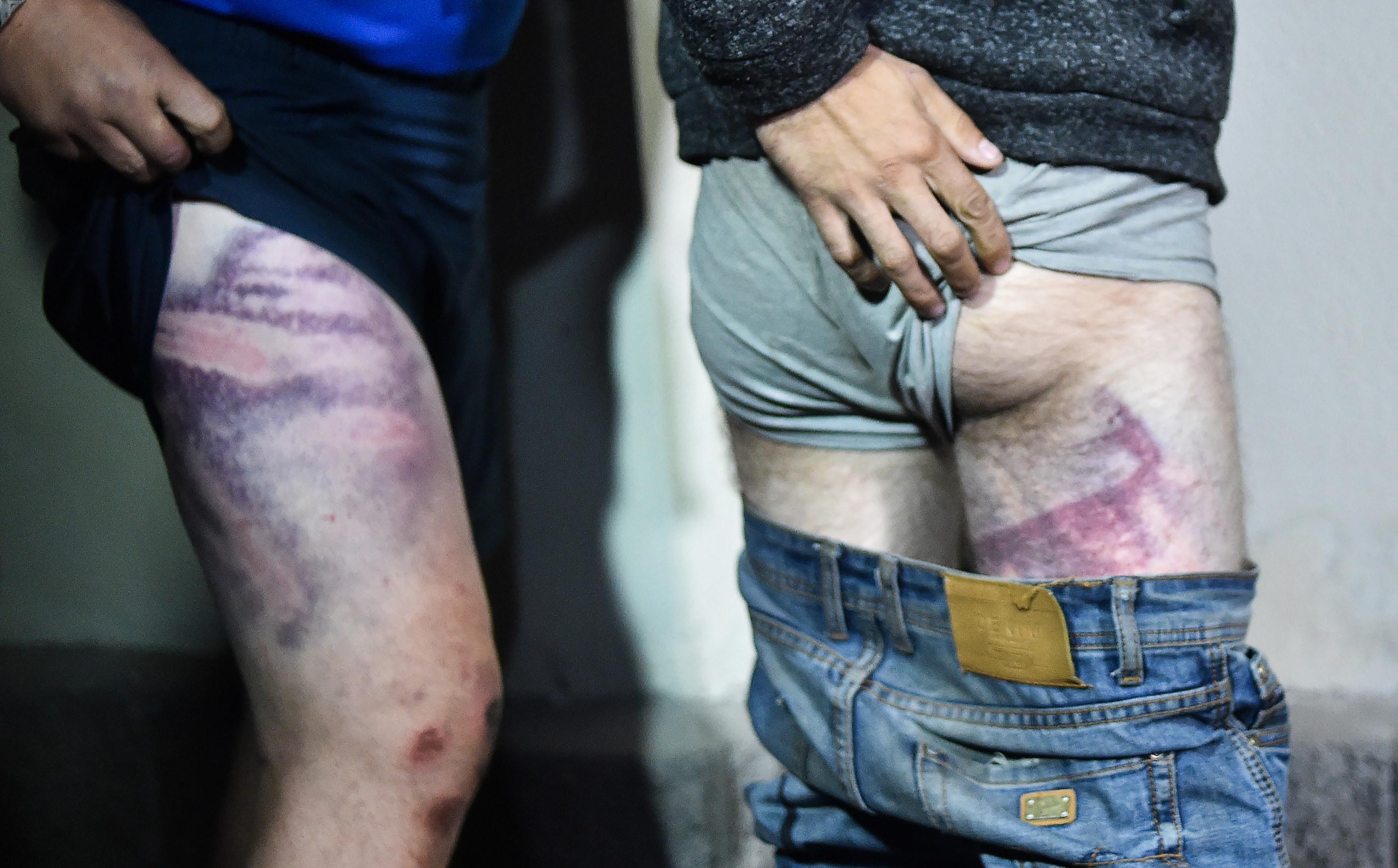 Two people lift up their shorts to show large bruises on their thighs