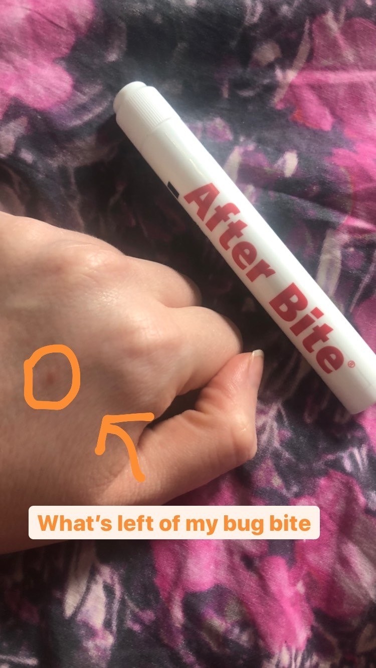 writer&#x27;s hand with small red mark and the tube of After Bite