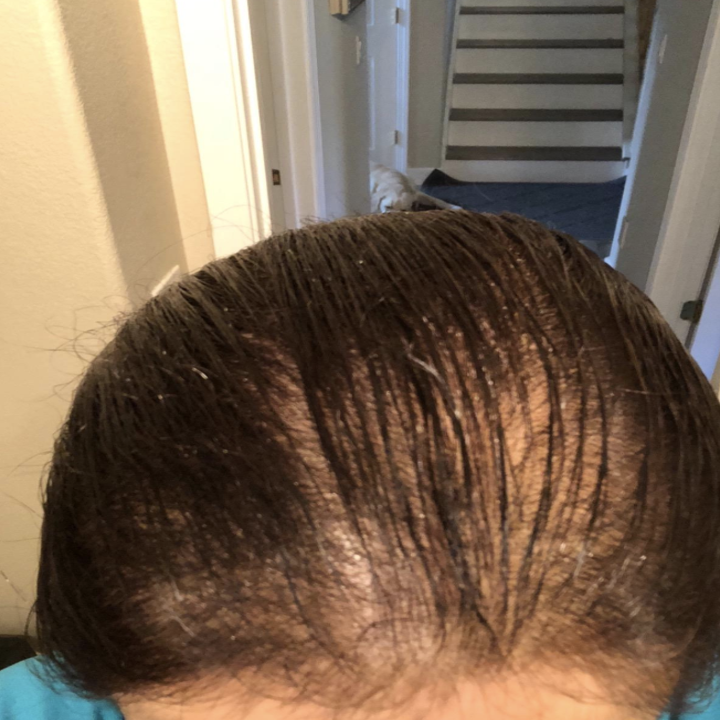 Reviewer image of thinning hair 