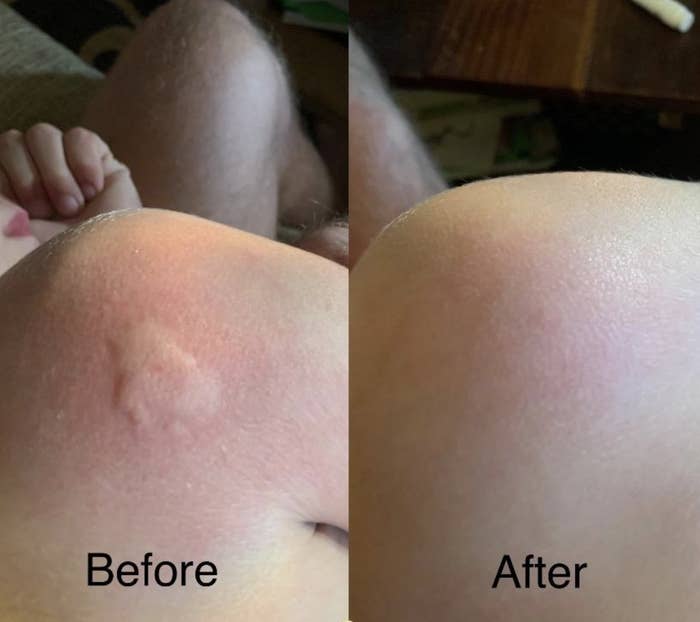 Reviewer before/after pic showing a big bite significantly less swollen after using the Bug Bite Thing Suction Tool