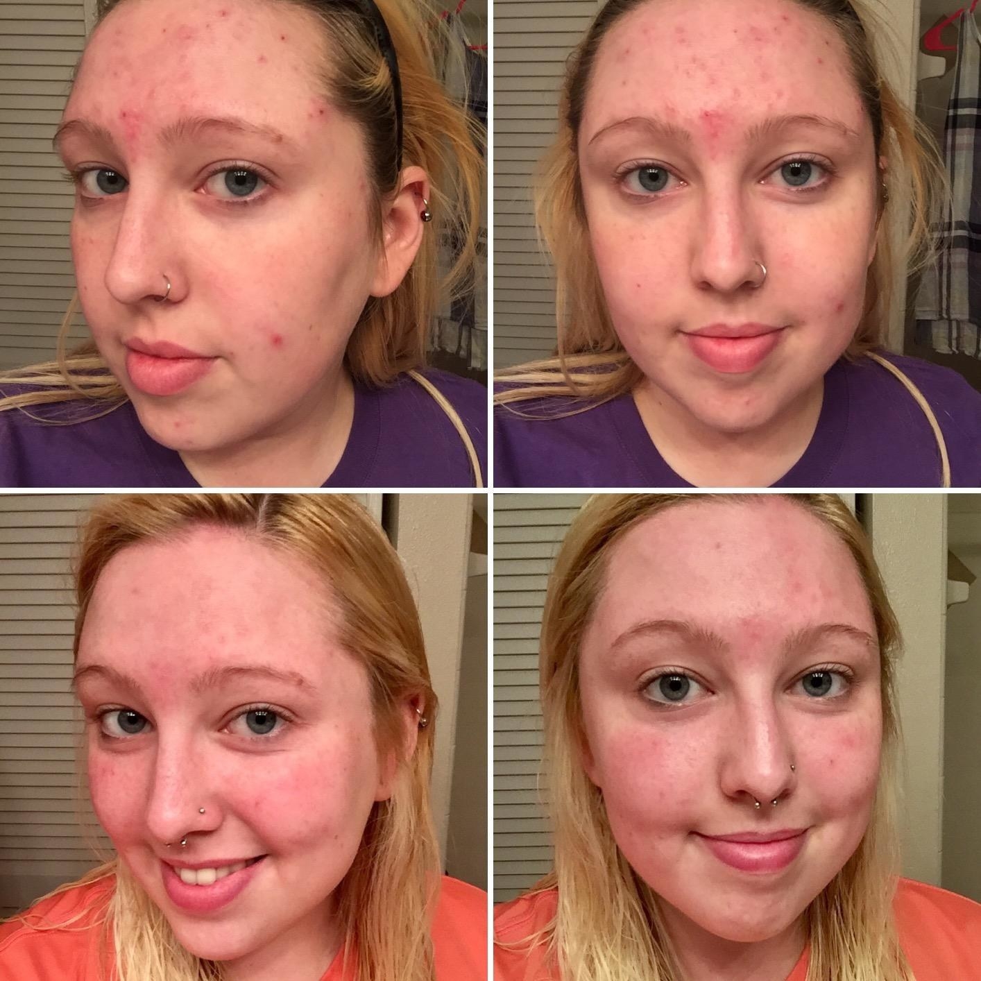 reviewer&#x27;s  acne scars and red textured skin before, then smoother texture and lesser acne and redness after using product