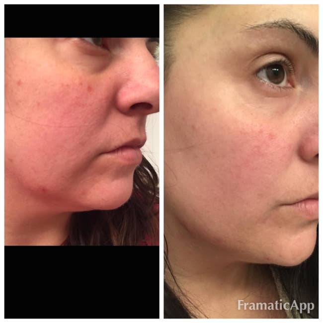 before and after of a reviewer with flushed uneven skin, then clear, more toned, less red skin after use of product