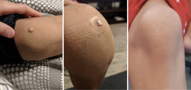 Before, during, after progression pic of reviewer's knee with a large wart. The after pic shows no wart after using the bandages.