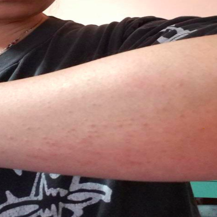 Reviewer showing their forearm after using the Bug Bite Suction Tool, showing no signs of a bug bite and skin looking clear and healthy in area that was previously inflamed 