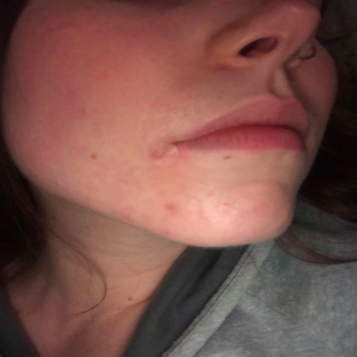 Reviewer photo showing Avarelle Acne Cover Patch applied over a pimple on their face next to their lip. 
