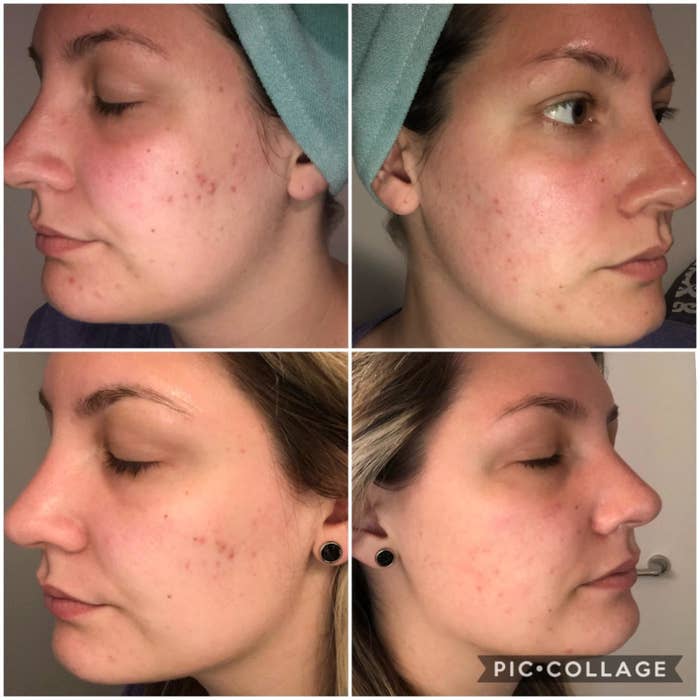 a four-photo collage of a before and after of reviewer&#x27;s acne-scarred skin, showing her scars slowly fading and her skin becoming more even-toned with time