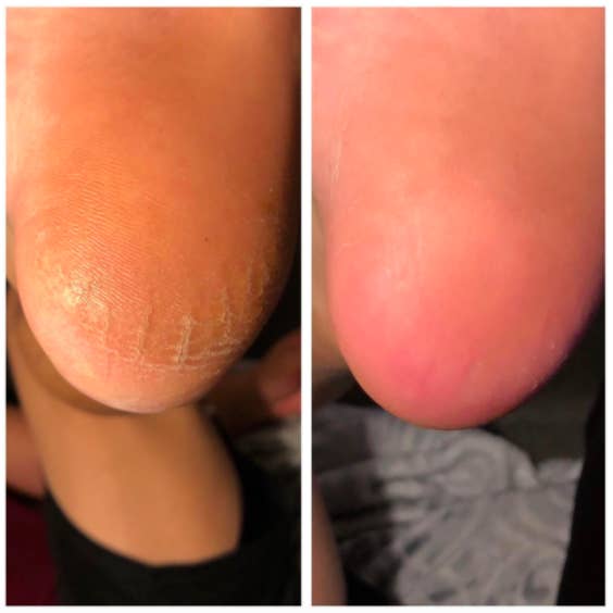 Reviewer photo showing before-and-after photos of their dry, cracked heel looking shiny and smooth after using Colossal foot rasp 