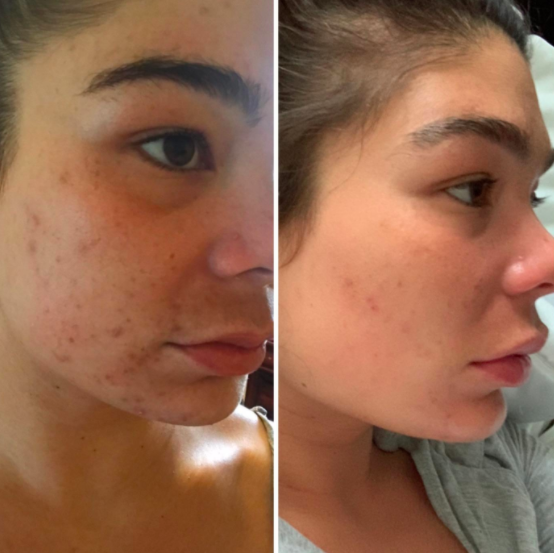 Reviewer before-and-after photos showing their skin with severe acne, and then visibly clearer skin after using Aztec Secret Indian Healing clay 