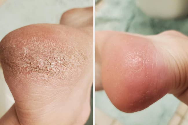 Reviewer's before photo of cracked skin on the foot and after photo of smooth skin