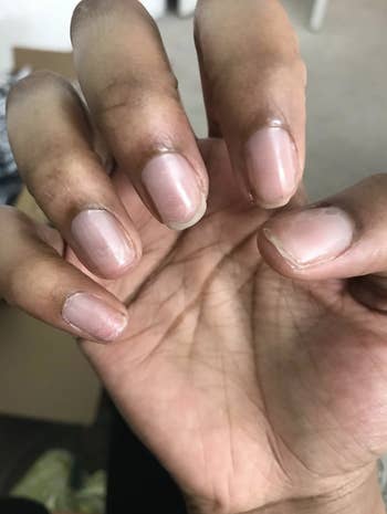 Reviewer's before photo showing short, damaged nails