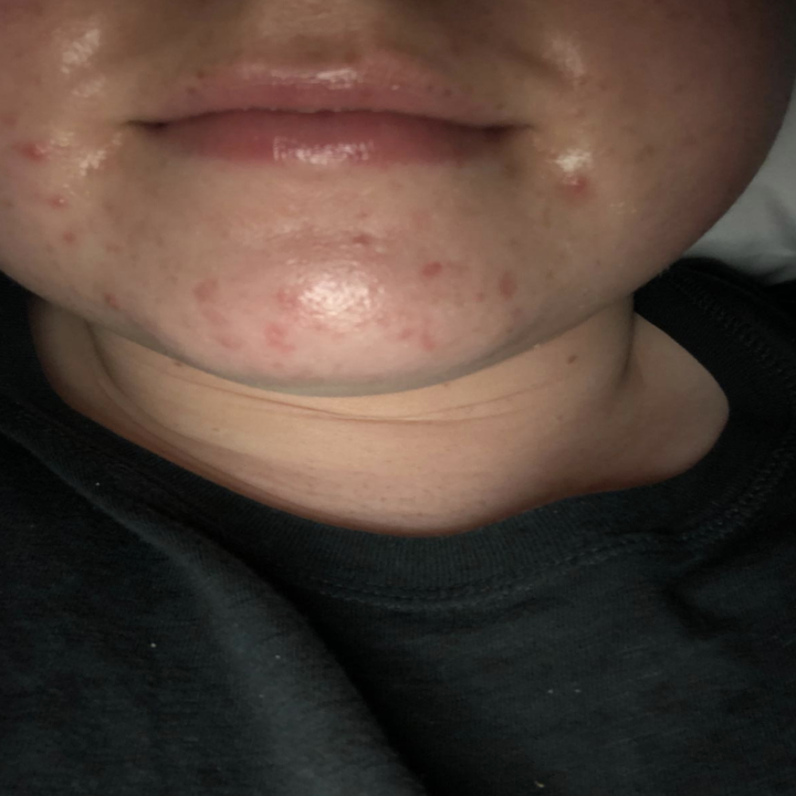 Reviewer's before photo showing small red blemishes and irritation on chin