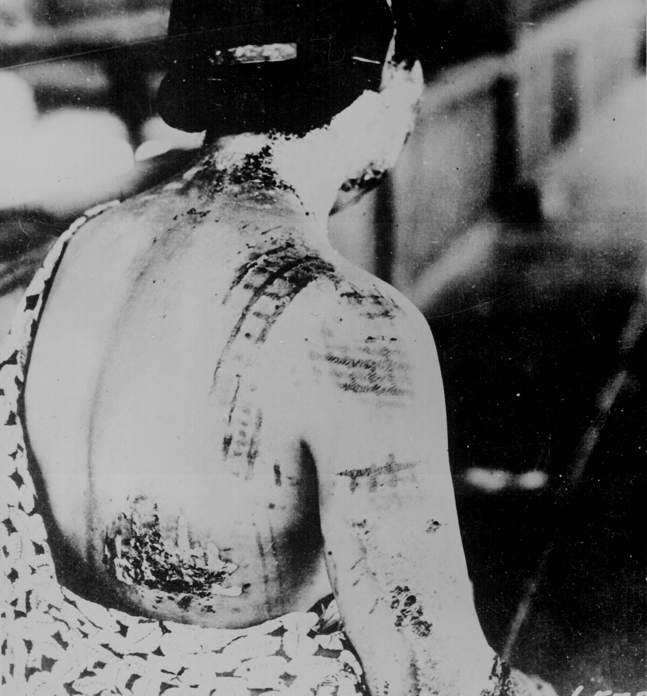 A woman reveals severe burns in gridlike patterns on her back caused by radiation