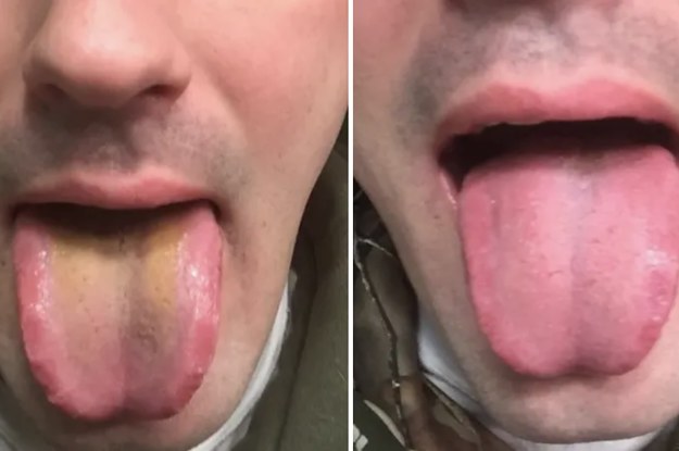 A tongue before and after cleaning