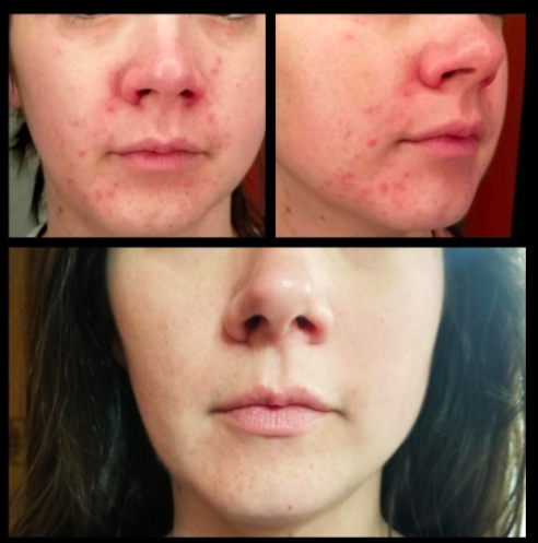 Reviewer before-and-after photos showing red skin and acne around their nose and mouth, with the same area being significantly cleared up after using the Differin Acne Treatment Gel 