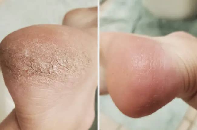 Reviewer before image of a cracked foot with an after image of the skin smooth 