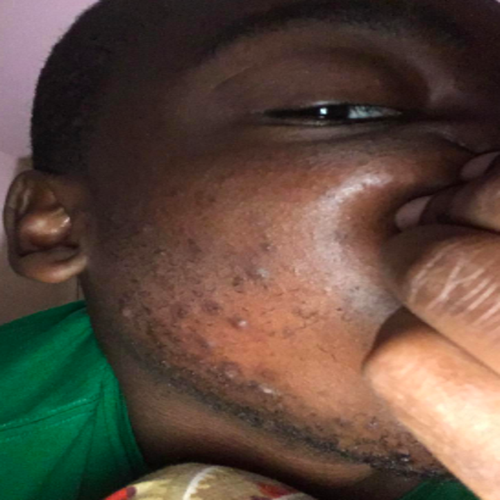 Reviewer with ingrown hairs and razor bumps on face from shaving