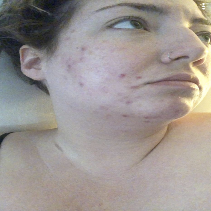 reviewer with visible redness and acne
