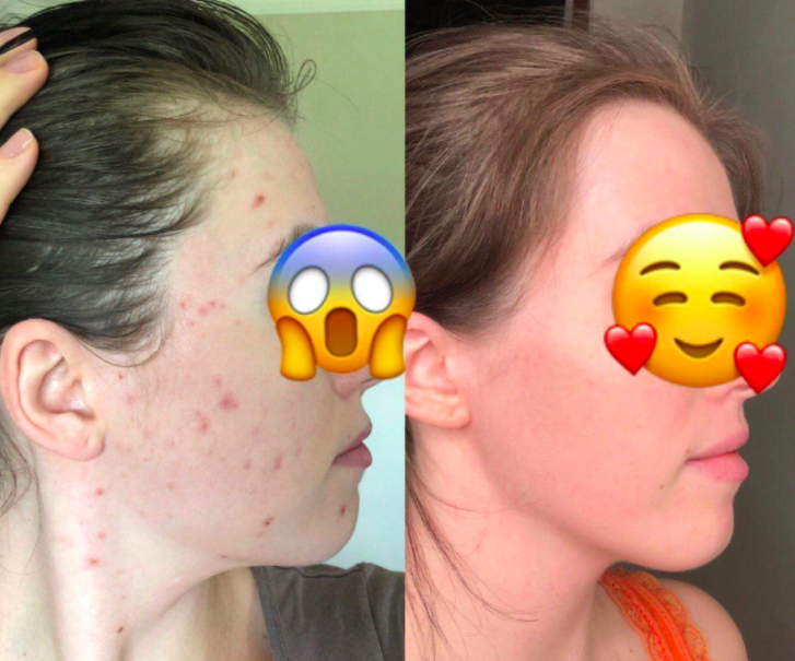 15 Products For Cystic Acne Our Readers Actually Swear By