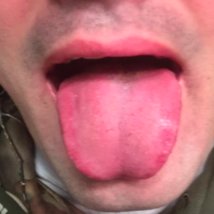 reviewer pic of same user's tongue now clean 
