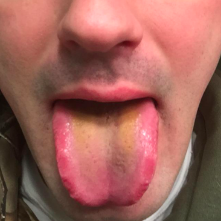 reviewer pic of yellow tinged tongue