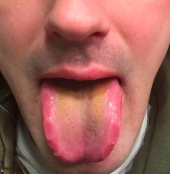 reviewer with yellow tinged tongue