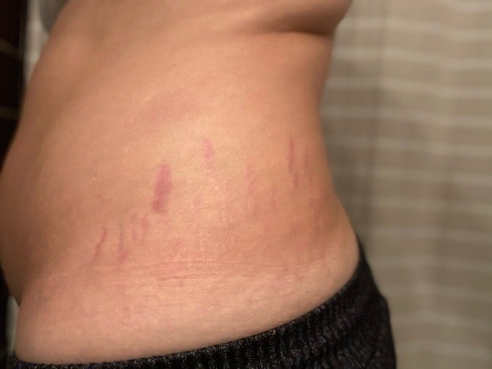 Photo of stretch marks.