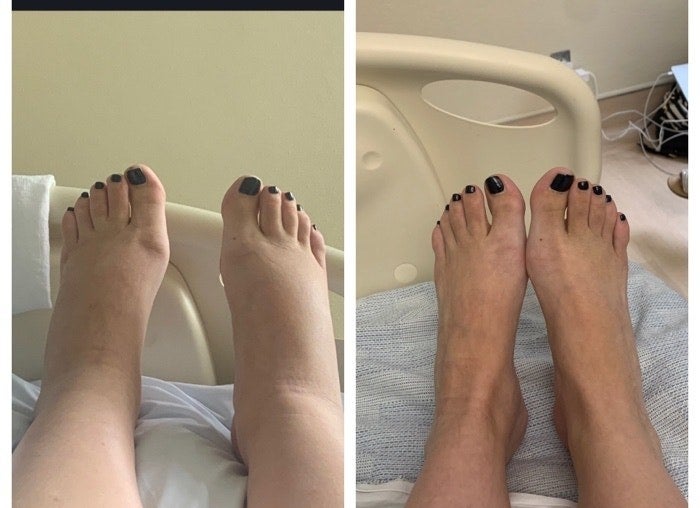 Photo of mom with swollen feet before and after.