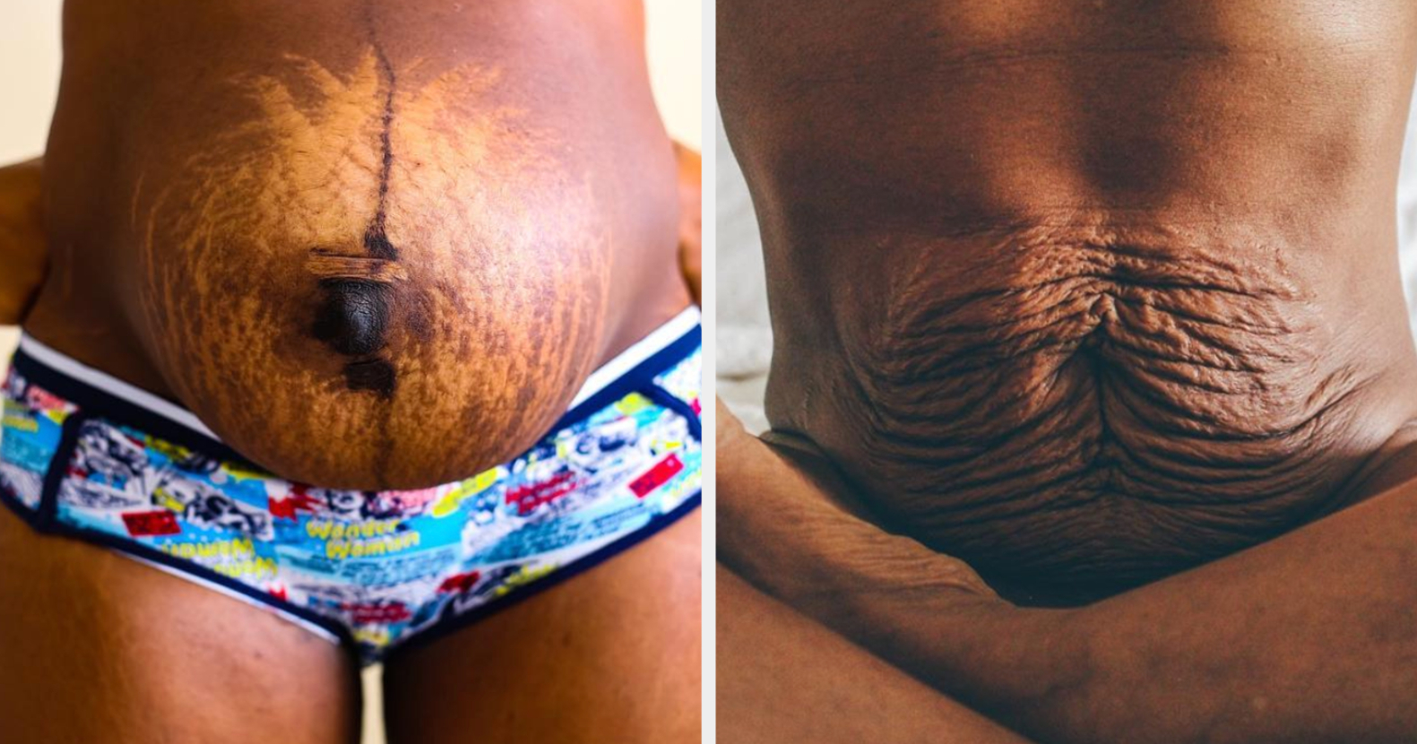 21 Awesome Photos That Show How Different Postpartum Bodies Can