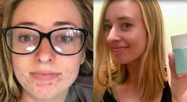 On the left, BuzzFeed Editor Sarah Wainschel showing she has acne on her chin, and on the right, Sarah Wainschel holding the BB Cream while showing her face is now clear of acne