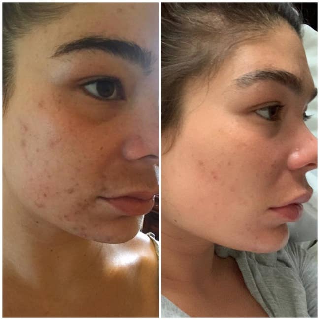 Before and after of a reviewer with patches of dark acne and scars on her cheek showing the mask dramatically reduced hyperpigmentation and helped get rid of breakouts