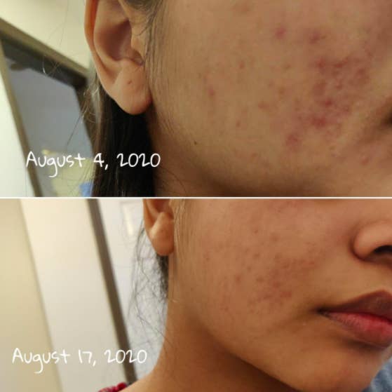 Reviewer photo showing their acne noticeably clearer after just two weeks of using the La Roche-Posay 3-step treatment