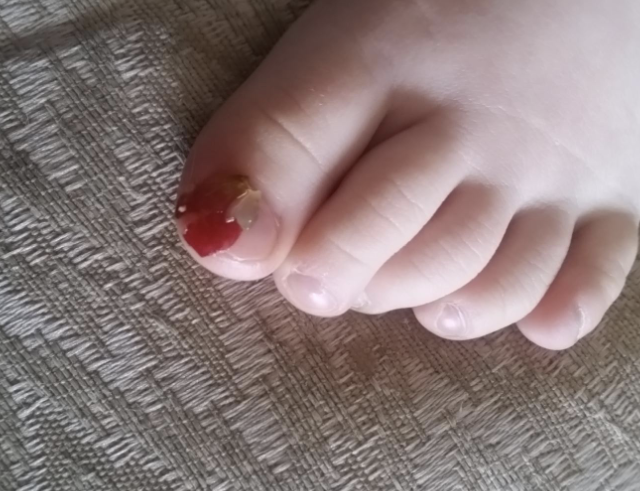 A toddler&#x27;s toe looks bloodied because a piece of a red grape is on it