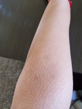 same reviewer's hairless arm after using epilator 
