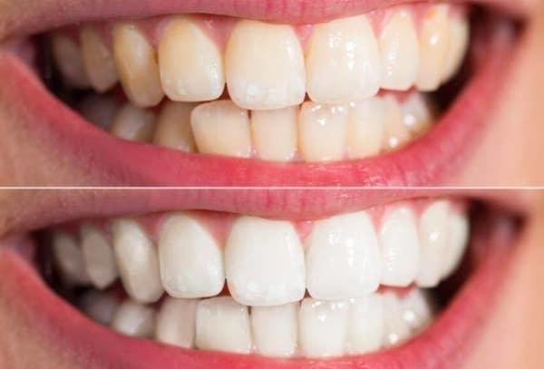On the top, a reviewer&#x27;s teeth looking a little yellow, and on the bottom, the same reviewer&#x27;s teeth looking whiter just a week later